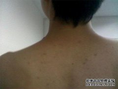 大学生有艾滋病的浪潮吗？无论性别，指甲都有
