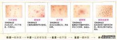 如何去除粉刺痤疮？痤疮怎么治疗？