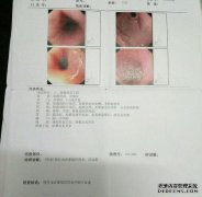 HP Gastrocamera是什么意思？