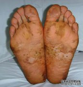 如果去皮。