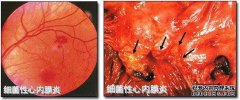 宫腔穿刺活检可以