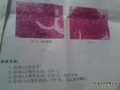 宫颈多发性鼻囊肿是什么病？