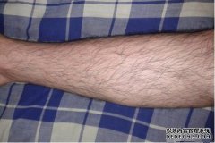 如果我的皮肤被脱毛膏灼伤了该怎么办？