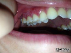 我的上牙龈长了粉刺...