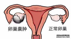 卵巢囊肿的IR值为0.67有什么意义？