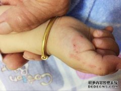 如果我的血管被注射破坏了怎么办？